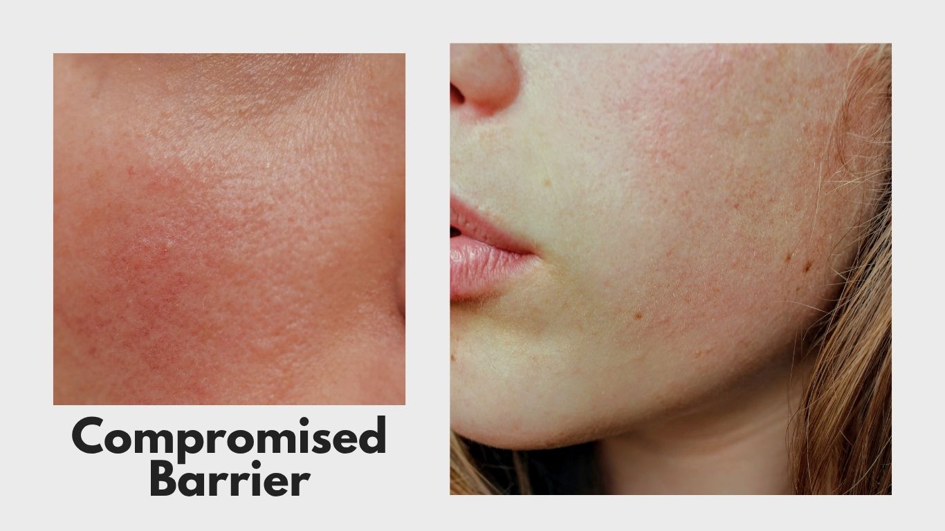 Dry, red, irritated skin.