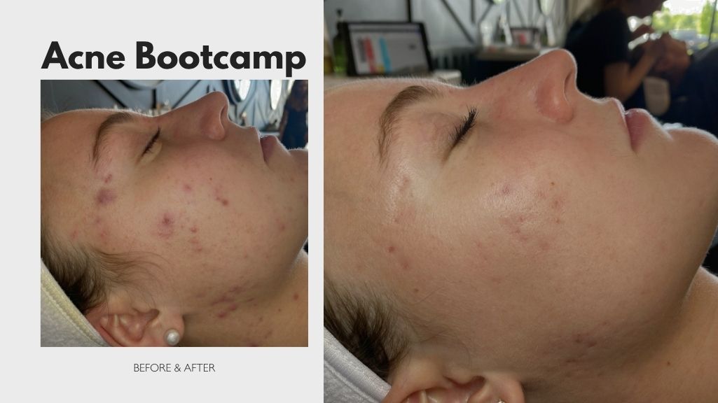 Client in our 90 day acne bootcamp results so far